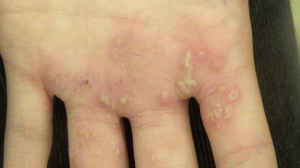 13-Year-Old Girl with Vesicular Sores on Palms