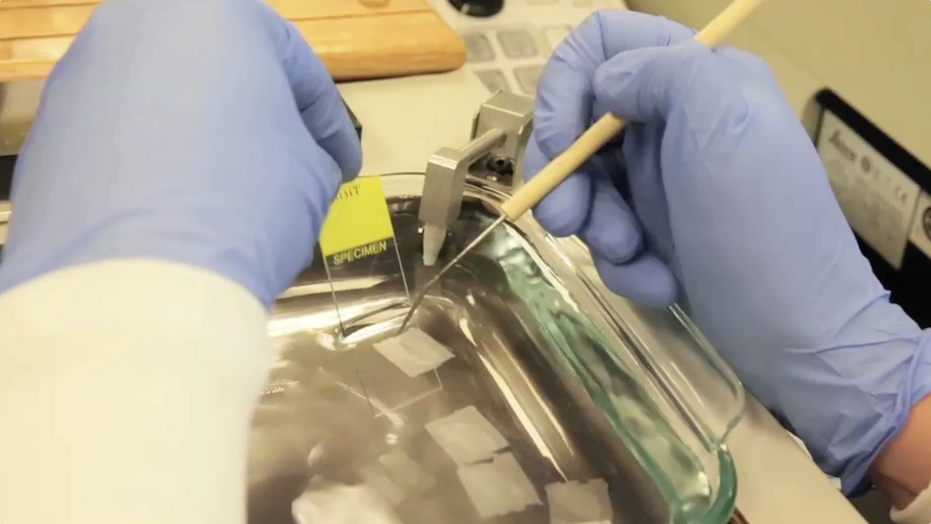 PSA Test Helps Low-Risk Patients Avoid Surgery and Radiation Thumbnail