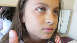 7-Year-Old Girl with 4-Days of Fever, Cough, and Rash
