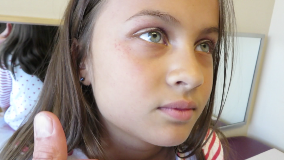 7-Year-Old Girl with 4-Days of Fever, Cough, and Rash - The Doctor's