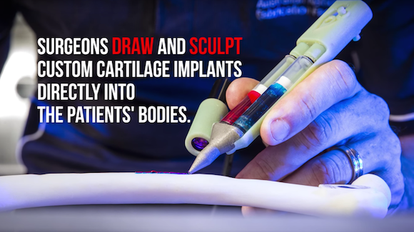 BioPen Draws Custom Cartilage Directly on Patients’ Bones Thumbnail