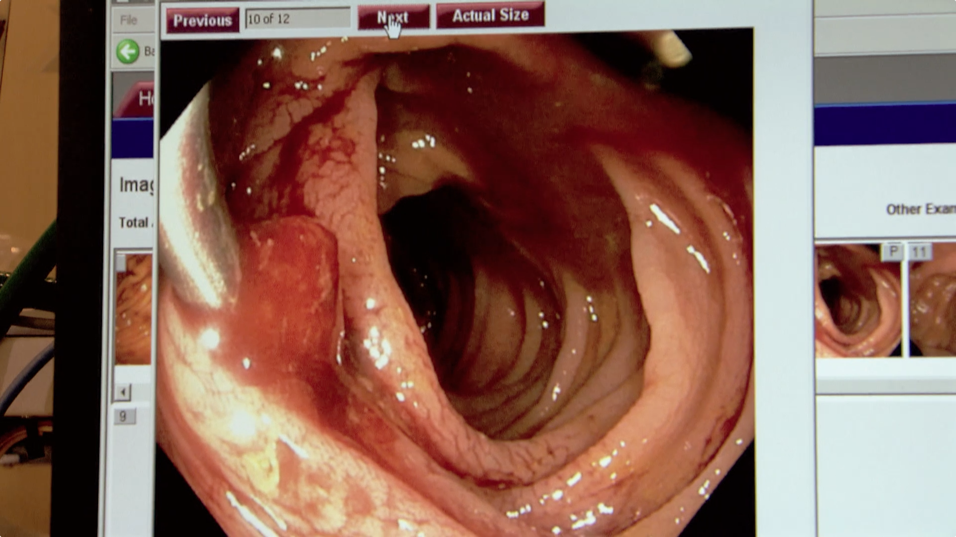 New Recommendations for Colorectal Cancer Screening Thumbnail