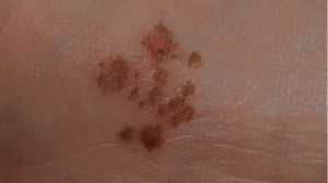 15-Year-Old Female with Pigmented Lesion on Right Sole