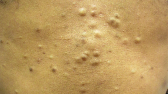 30-Year-Old Male with Asymptomatic Lesions on Abdomen - The Doctor's