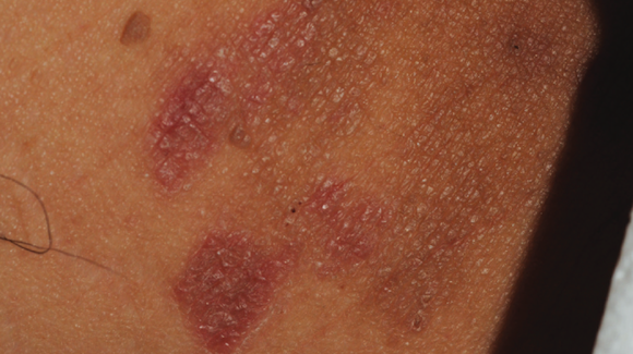 57-Year-Old Female with Bilateral Inguinal Rash - The Doctor's