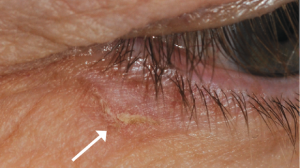 62-Year-Old Male with Asymptomatic Lesion On Eyelid Area