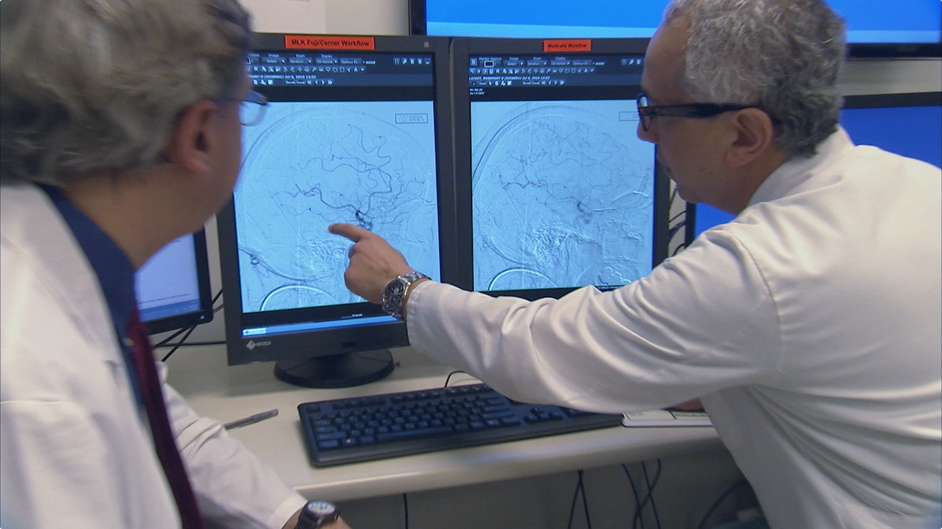 Early Stroke Treatment Improves Patient Outcomes Thumbnail