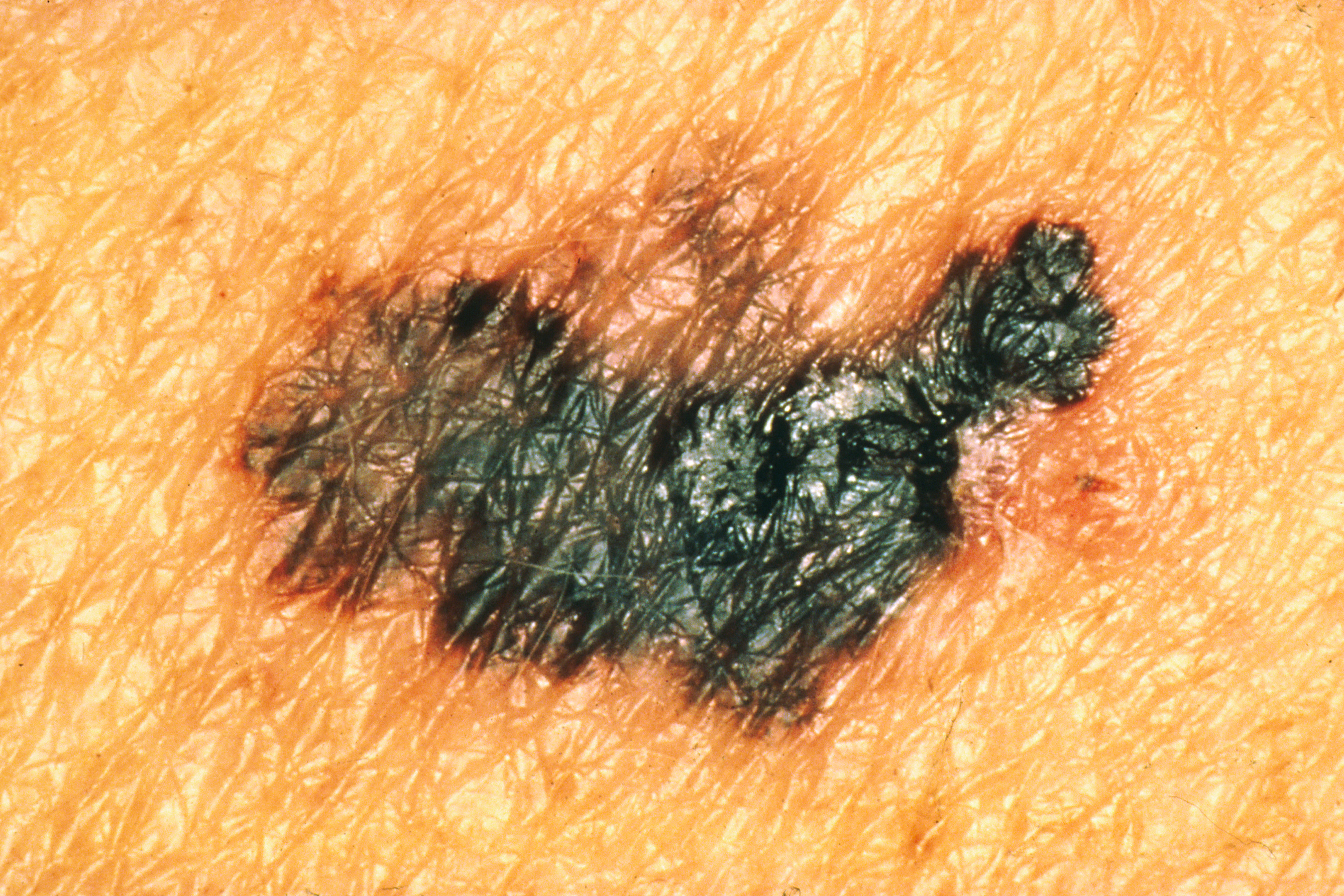 USPSTF Drops Annual Skin Cancer Screening Recommendation Thumbnail