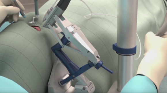 World’s First Robot-Assisted Inner Eye Surgery Thumbnail