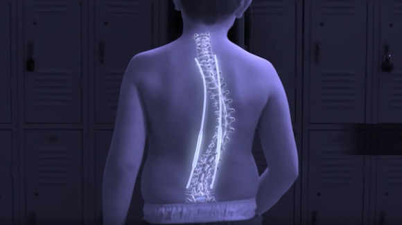 Magnetic Rod System Minimizes Invasive Scoliosis Procedures Thumbnail
