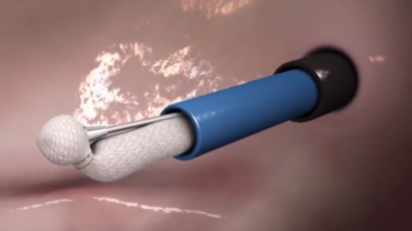 Fix Leaky Heart Valves without Open-Heart Surgery Thumbnail