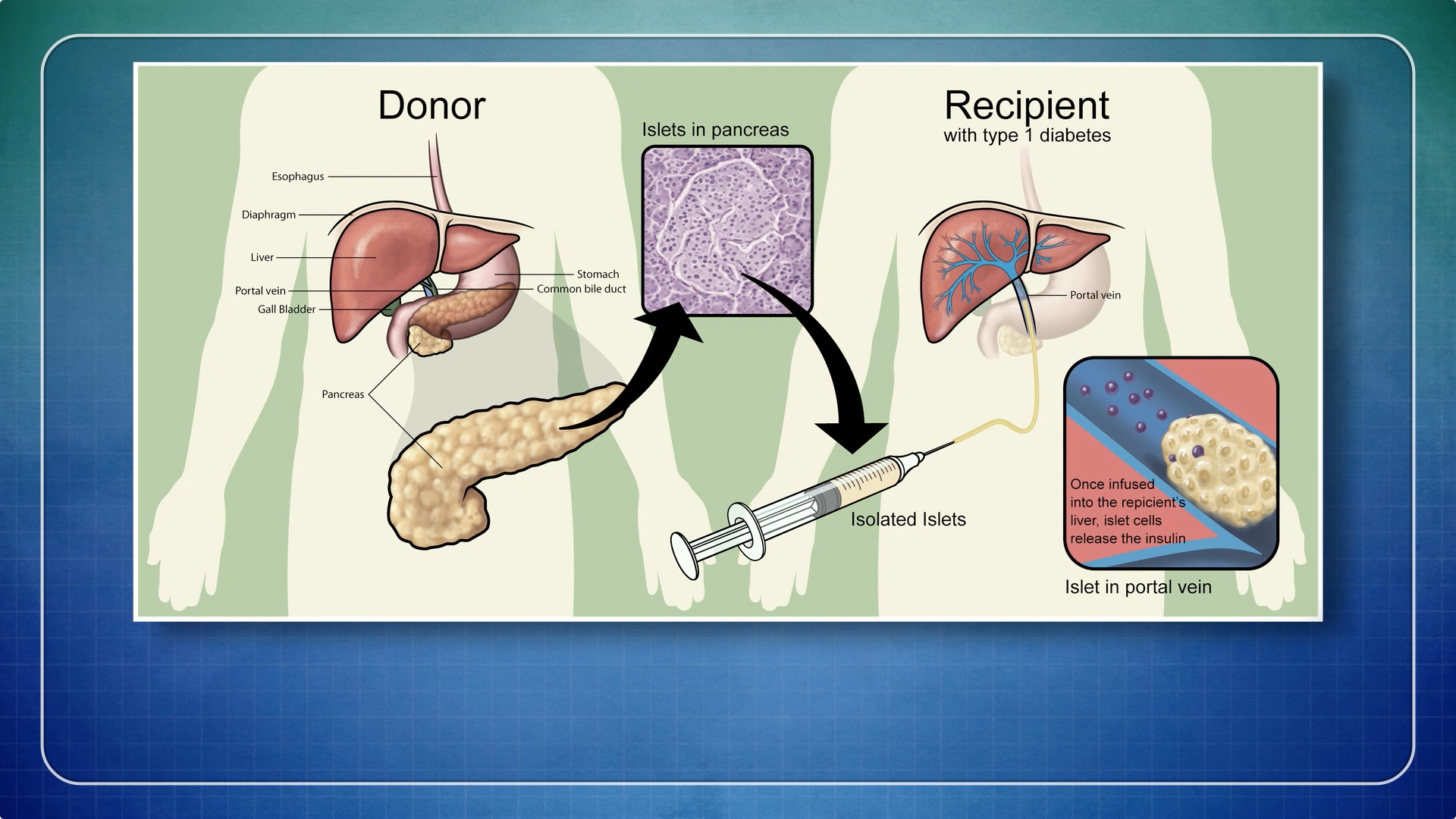 Minimally Invasive Procedure Mimics Pancreas Transplantation Thumbnail