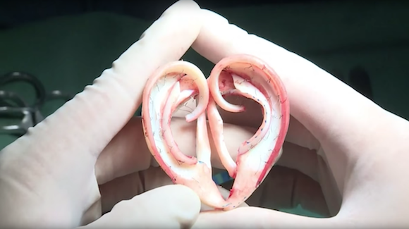 Surgeons Help Patient Grow Replacement Ear on His Own Arm Thumbnail