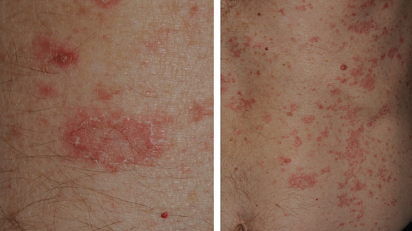 60 Year Old Male With Asymptomatic Rash On Trunk And Extremities The