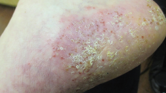 Dyshidrosis ekcéma curezone pikkelysömör