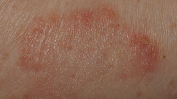 57-Year-Old Female With 2-Day History of Sore Bumps on Trunk