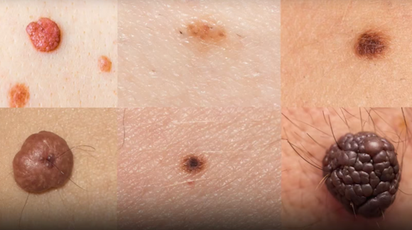 Can a Computer Really Diagnose Skin Cancer? Thumbnail