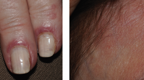 old blood 3 test year 78 Female  on The Old with Face and Year Rash  Hands