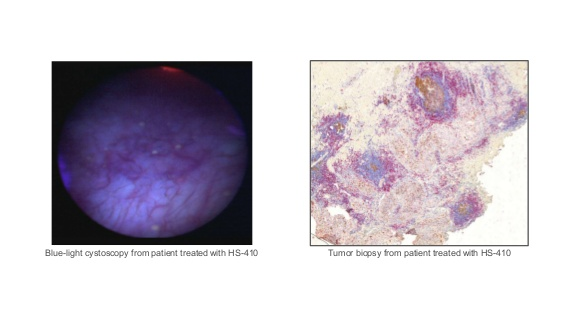 Exploring Possible Adjunct to BCG Therapy for Patients with Bladder Cancer Thumbnail