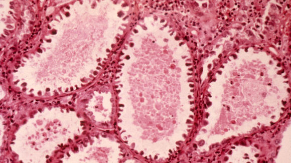 The Cause of Nearly All Cervical Cancers Thumbnail