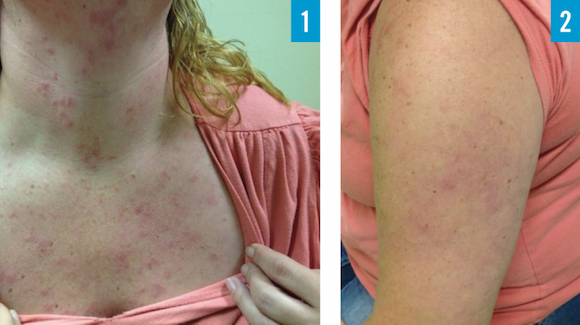 37-Year-Old Female with Pruritic Rash on Upper Body - The ...