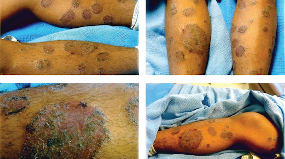 view year female with pruritic rash upper body derm case challenge view year female with pruritic rash upper body derm case challenge