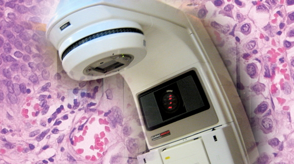 Pelvic Radiotherapy Provides Long-Term Palliation In Patients With Bladder and Prostate Cancer Thumbnail