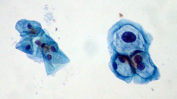 HPV: A Human Carcinogen Thumbnail