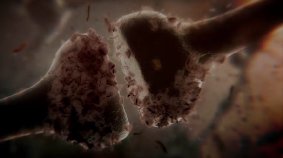 Genetic Test Determines Who May Develop Alzheimer’s… And When Thumbnail
