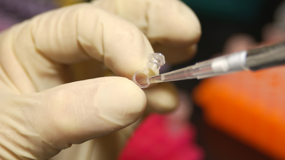 New DNA Test Detects Mutations in Urine of Bladder Cancer Patients Over a Decade Before Diagnosis Thumbnail