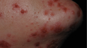 10-Year-Old Male with Spreading Itchy Eruption