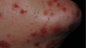 What is the cause of this woman's rash?