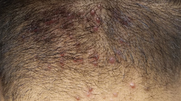 27-Year-Old Male with Bumps on Scalp and Neck - The Doctor's Channel