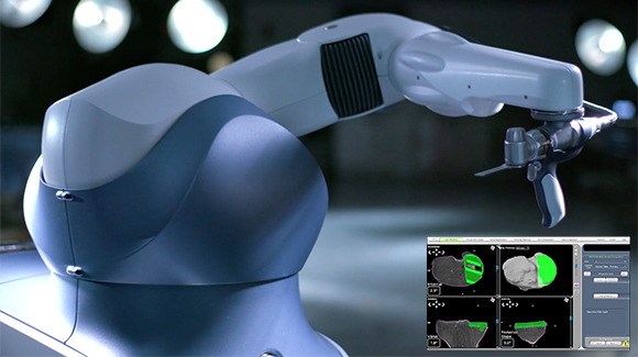 Robotic-Arm Assisted Surgery for Hip & Knee Replacements Provides Actionable Intra-Operative Data Thumbnail