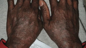 45-Year-Old Male with Photodistributed Rash