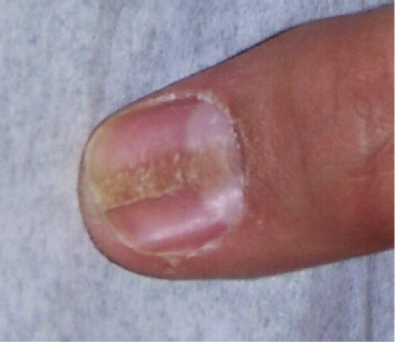 With hypothyroidism, are the finger nail ridges you get from this condition  vertical or horizontal? - Quora