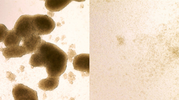 Zika Virus Appears to Preferentially Target Glioblastoma Stem Cells Thumbnail