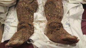 Unna Boot Bandage Primer | forum.iktva.sa