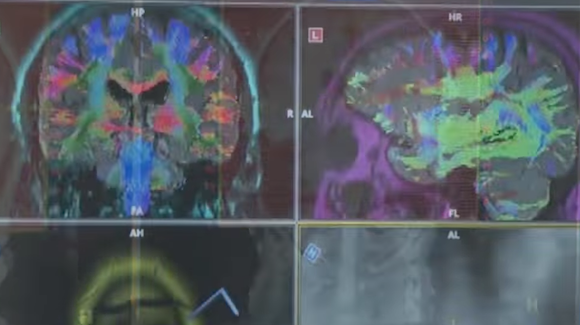 First CTE Diagnosis During Life Confirmed After Patient’s Death Thumbnail
