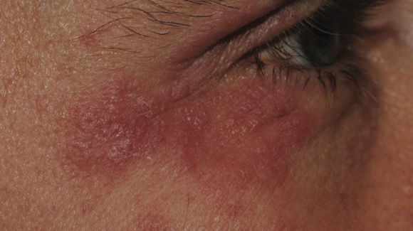 43-Year-Old Male with Asymptomatic Papules on Both Eyelids - The Doctor