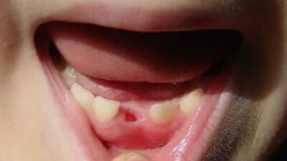 Doctor Urges Parents to Hold on to Their Kid’s Baby Teeth Thumbnail