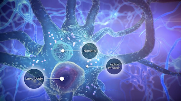Investigational Therapy Aims to Block Toxic α-Synuclein Propagation Thumbnail