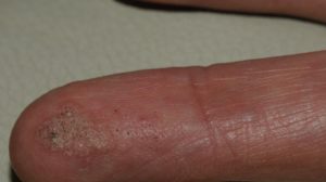 72-Year-Old Male with Asymptomatic Lesion On Left Index Finger