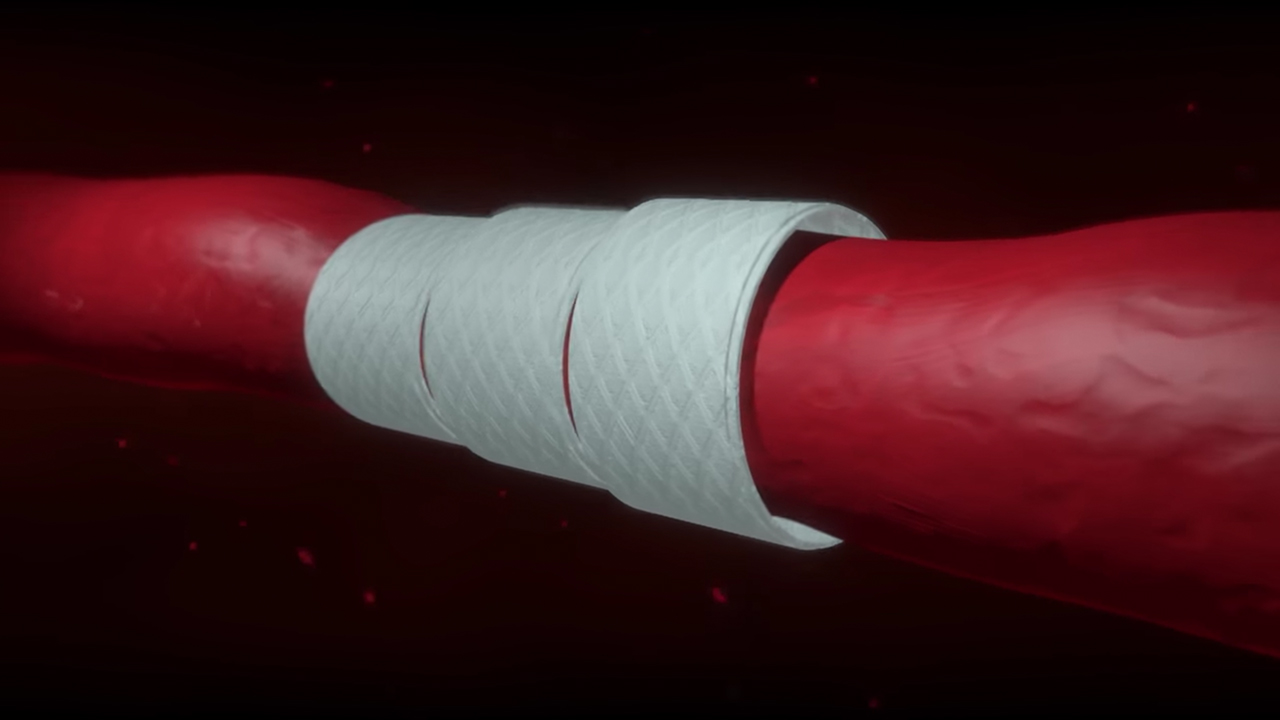 Wireless Aorta Cuff as a Blood Pump for Heart Failure Thumbnail