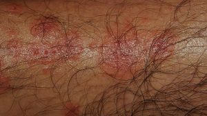 45-Year-Old Male with Tender Papules on Palms and Soles