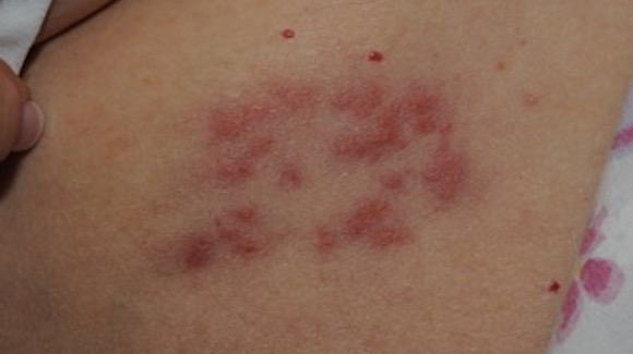 57-Year-Old Female With 2-Day History of Sore Bumps on Trunk