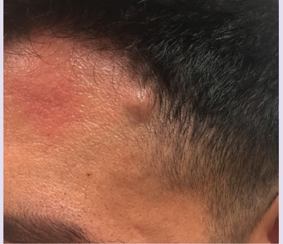 21-year-old-male-with-painless-swelling-on-left-temple-the-doctor-s