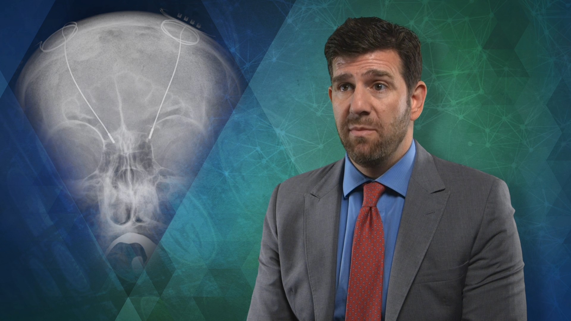 Closed-Loop Brain Stimulation Systems Are Getting Smarter Thumbnail