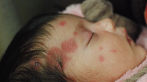 29-Day-Old Female With Erythematous Eruption