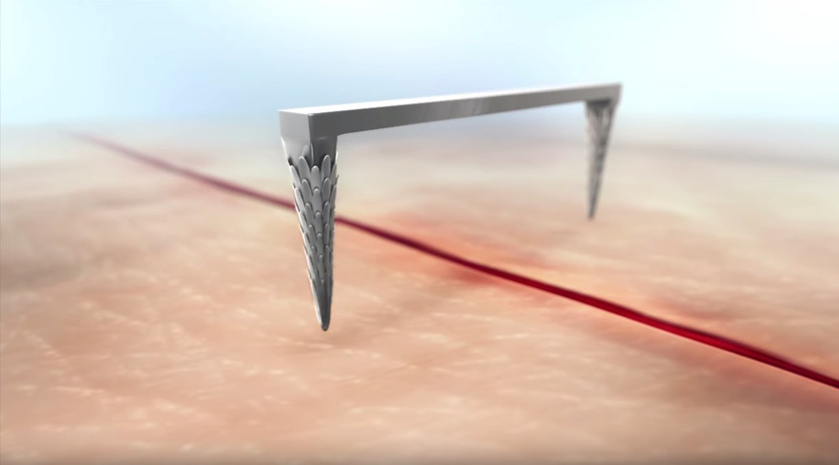 Nature Inspires Research Team’s Quest for Better Surgical Staples Thumbnail